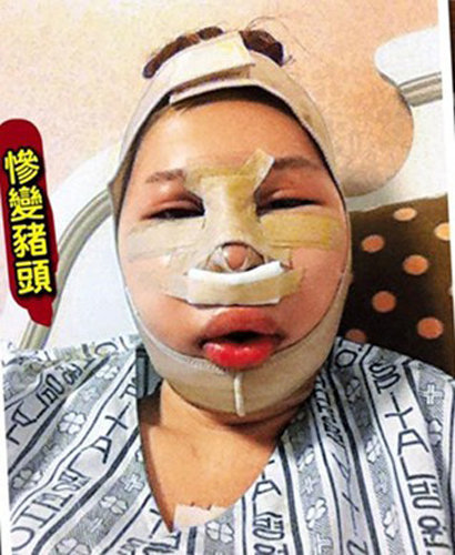 《喜爱夜蒲》女星整容肿至猪头痛不欲生